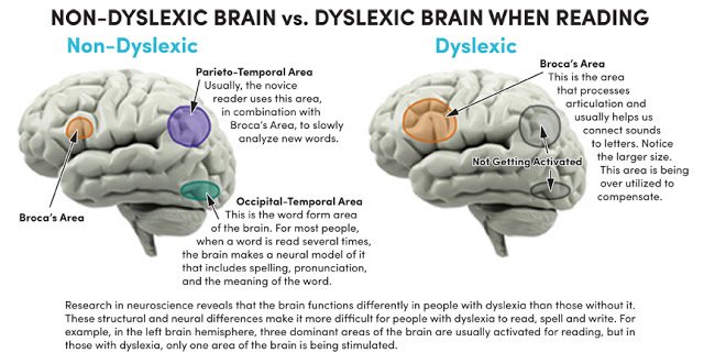 dyslexia, brain, intervention, practice