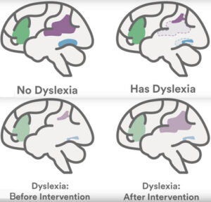 dyslexia, intervention, yoga, brain, neuroplacticity